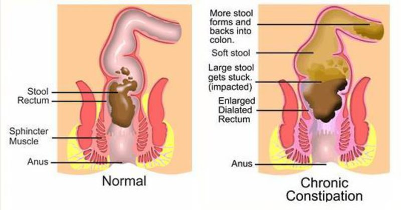 Homeopathy Treatment for Constipation in Malleswaram