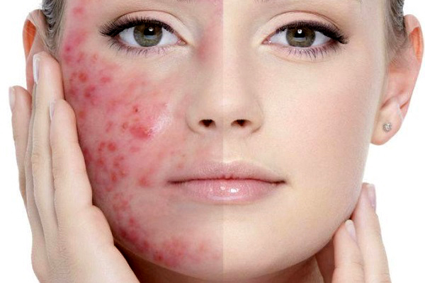 Homeopathy Treatment for Acne in Malleswaram