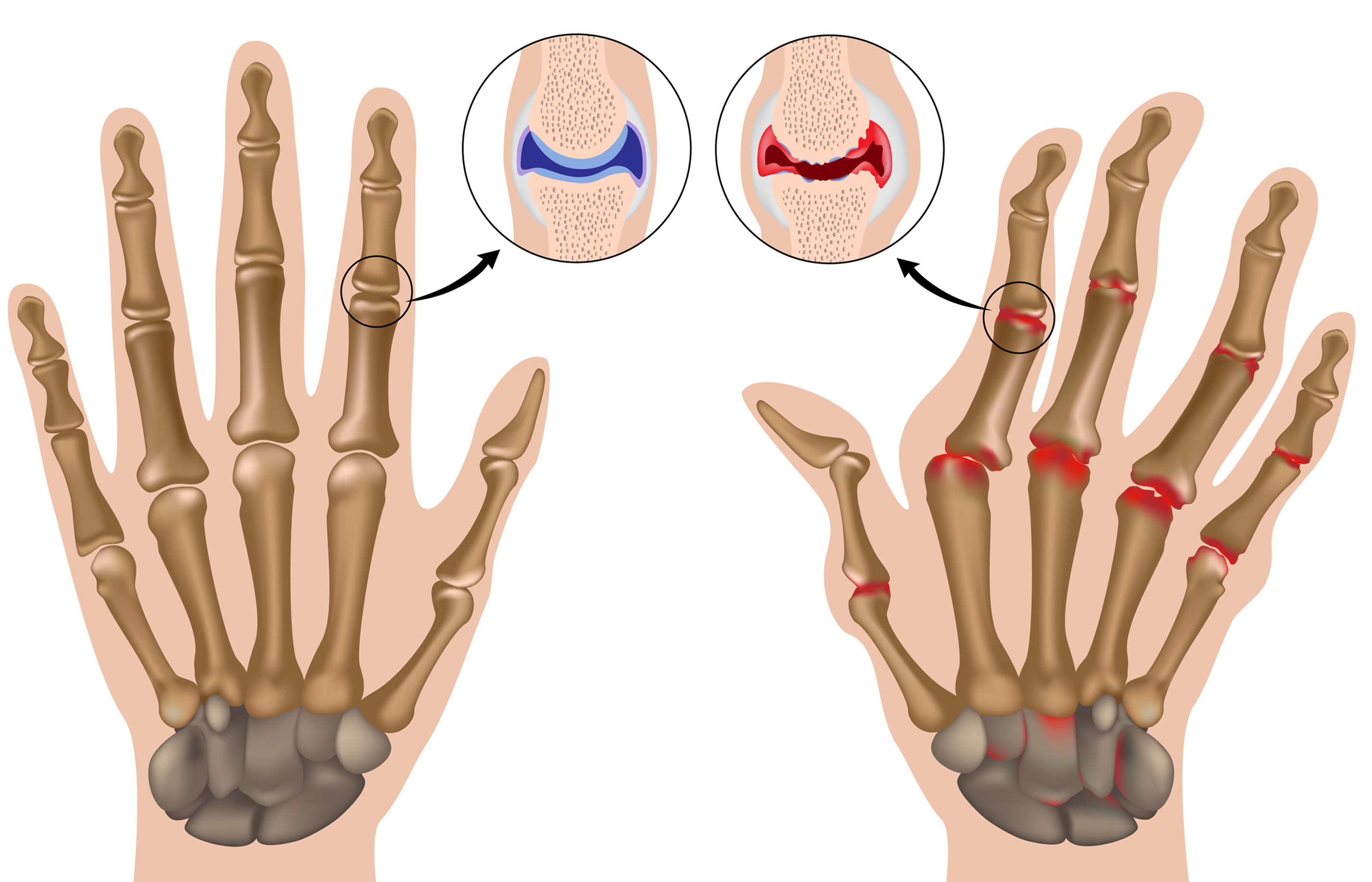 Homeopathy Treatment for Arthritis in Malleswaram