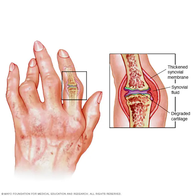 Homeopathy Treatment for Rheumatoid Arthritis in Malleswaram